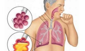 5 bệnh về hô hấp hay gặp nhất