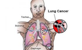 Hãy cùng tìm triệu chứng của ung thư phổi giai đoạn 1